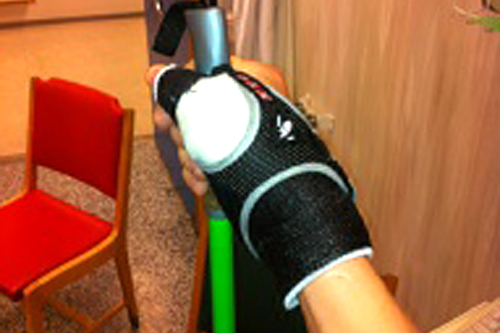 Øystein Pølsa Pettersen med spesialtilpasset gips etter sitt tommelbrudd i romjula 2011. Foto: Privat.