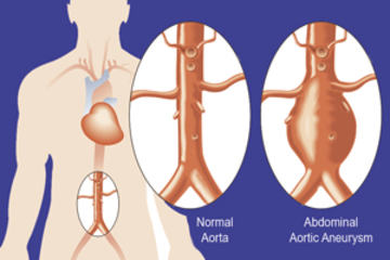 bs_AorticAneurysm_52914034_300
