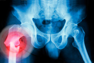 bs-Fracture-78724343-300x200