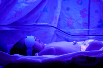 bs_Baby_Phototherapy_27601295_300