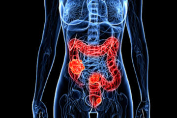 bs_colon_cancer_7771065_300