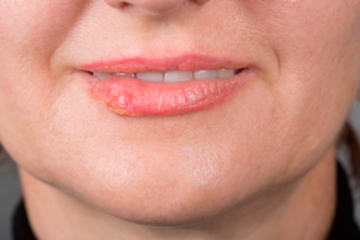 bs-Lip-herpes-106460990_300