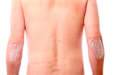 bs-Psoriasis-6556712_300