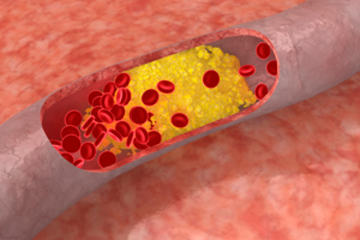 bs-Cholesterol-artery-9241484-300x210