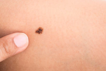 bs-Birthmark--87122651-300