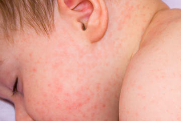 bs-Baby-Dermatitis-150062105-400