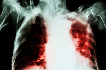 bs-Tuberculosis-105632375-400