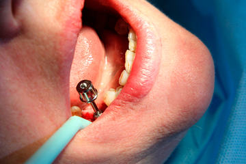 bs-implantat-200727259-400