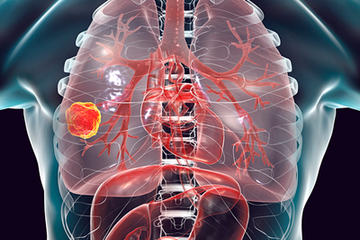 bs-Lung-Cancer--235125928-400