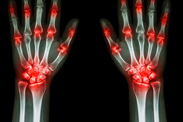 bs-Joint-Arthritis-102405704-400
