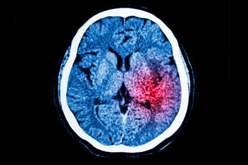 bs-Ct-Scan-Of-Brain-91233920-360