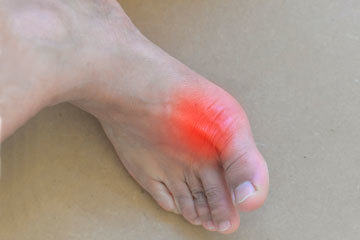 bs-Painful-Gout--205385137-360