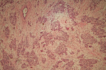 bs-cancer-172719983-360