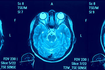 bs-brain-MRI-slide-79004011-360