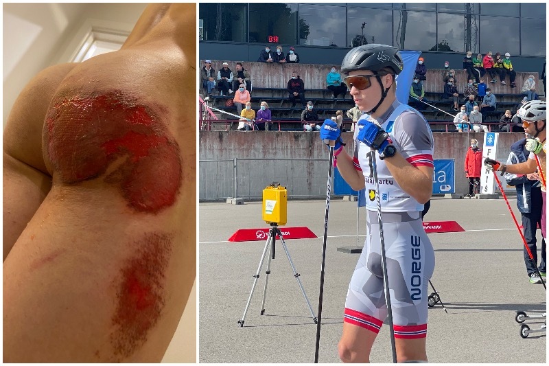 Patrick Fossum Kristoffersen pådro seg blant annet et heftig kjøttsår etter skrekkvelten i rulleskicupen i Estland på lørdag. Foto: Privat Patrick Fossum Kristoffersen pådro seg blant annet et heftig kjøttsår etter skrekkvelten i rulleskicupen i Estland på lørdag. Foto: Privat