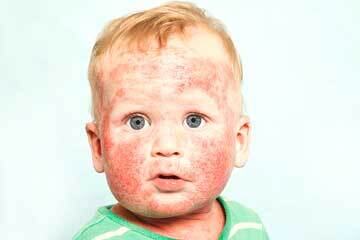 bs-baby-dermatitis-120939194-360