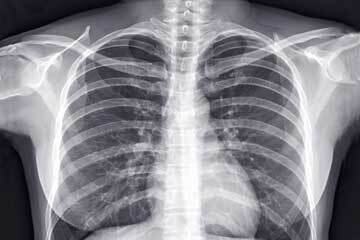 bs-Chest-X-ray-320084674-360